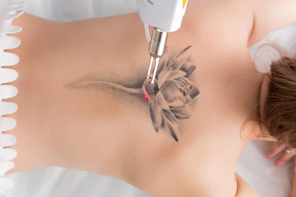 laser tattoo removal london