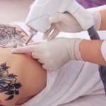 Selecting the right laser treatment for your tattoo.