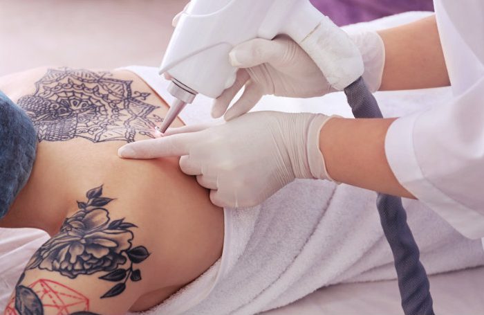 Selecting the right laser treatment for your tattoo.