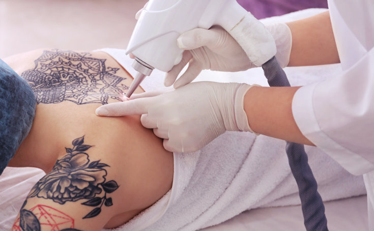 Selecting the right laser treatment for your tattoo.